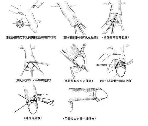 最新割包皮技术，改变男性健康的新里程碑